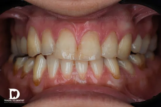 Imagen de los dientes de Julian Martinez Gonzales antes.