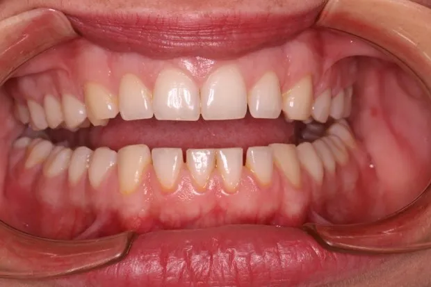 Imagen de los dientes de Vanessa Ortega Ramirez antes.