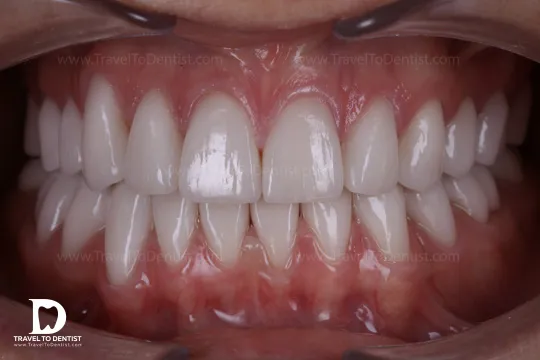 Imagen de los dientes de Julian Martinez Gonzales despues.